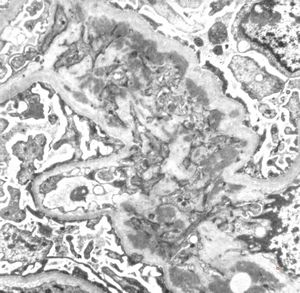 M,21y. | IgA nephropathy (Berger disease) M,21y. | IgA nephropathy (Berger disease)